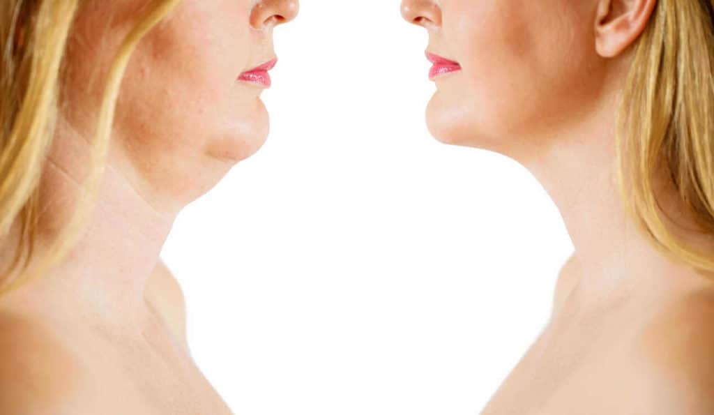 Double Chin treatment Goadby before and after results