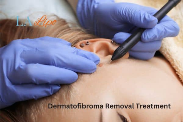 Dermatofibroma Removal Treatment Goadby