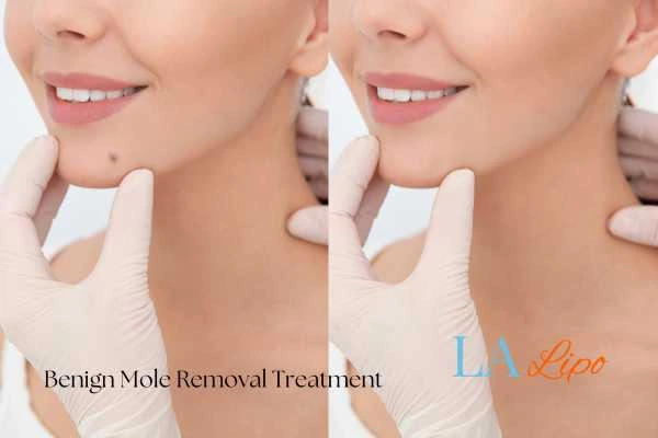 woman's before and after mole removal Goadby results