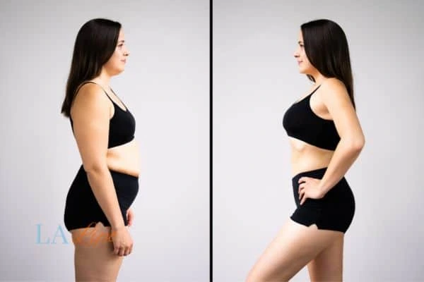 image of woman before and after results of LA-EMS Body Sculpting Goadby to help treat Diastasis recti