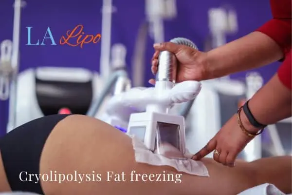 women getting fat freezing Goadby