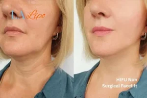 hi-fu for wrinkles Goadby before and after results
