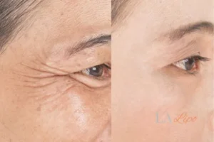 Before and after results of woman - HI-fu wrinkles reduction treatment Goadby