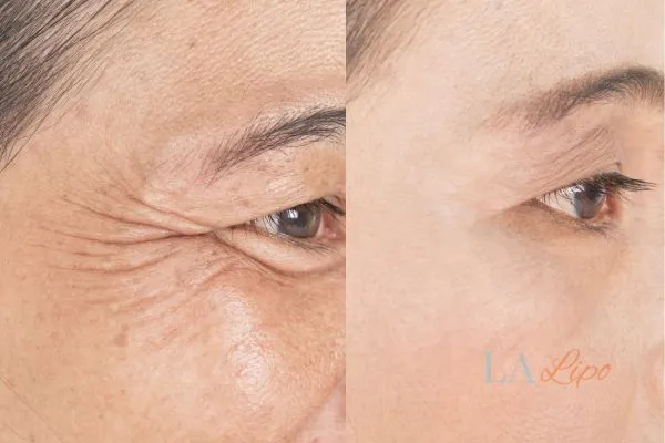 Before and after results of woman - HI-fu wrinkles reduction treatment Goadby