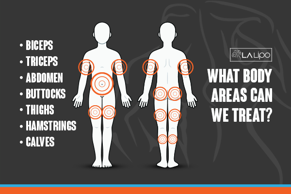 Graphic to show areas you can have LA-EMS Body Sculpting Goadby treatment.