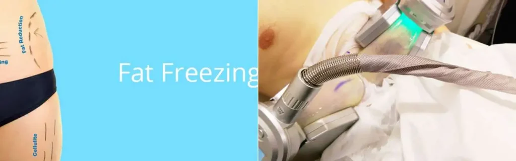 Fat freezing Goadby on multiple areas of the body