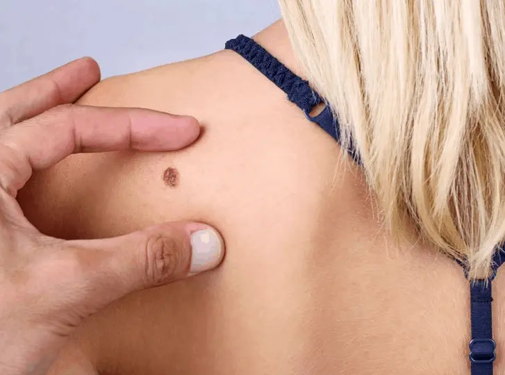 woman having mole removal Goadby consultation before treatment.