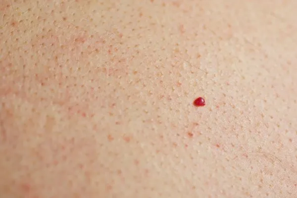 close up of a cherry angioma Goadby