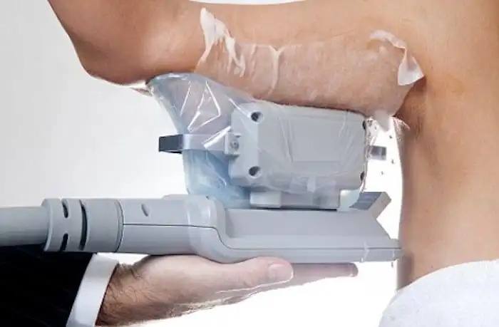 Picture of fat freezing Goadby on the upper arms.