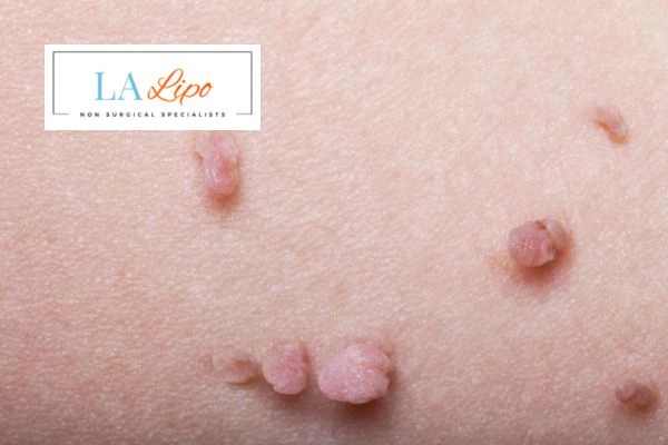 Does cryopen skin tag removal Goadby hurt? Find out now call our team today!
