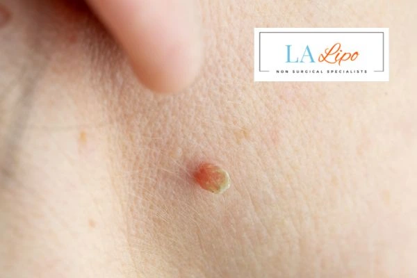 Book skin tag removal Goadby today speak to our team now!