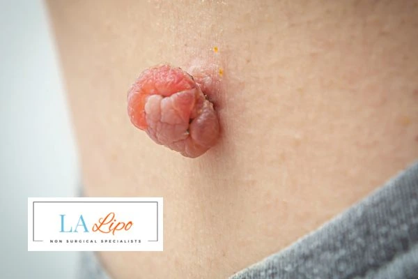 Interested in skin tag removal Goadby? Concerned about the pain? Find out more today!