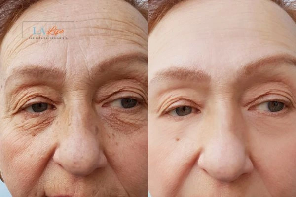 The powerful benefits of Morpheus8 Treatment Goadby - Call Our team today!