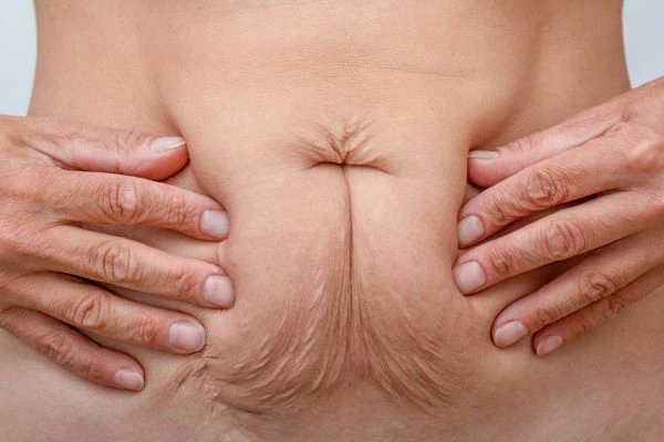 Should I Combine Diastasis Recti Treatment with Body Contouring for Better Results Goadby?
