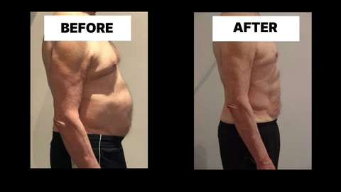 What Symptoms Can Diastasis Recti Cause in Men? Weak Core, Back Pain and Poor Posture Goadby